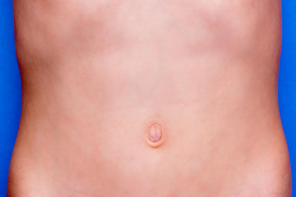 Rectocele (Intestinal Hernia)