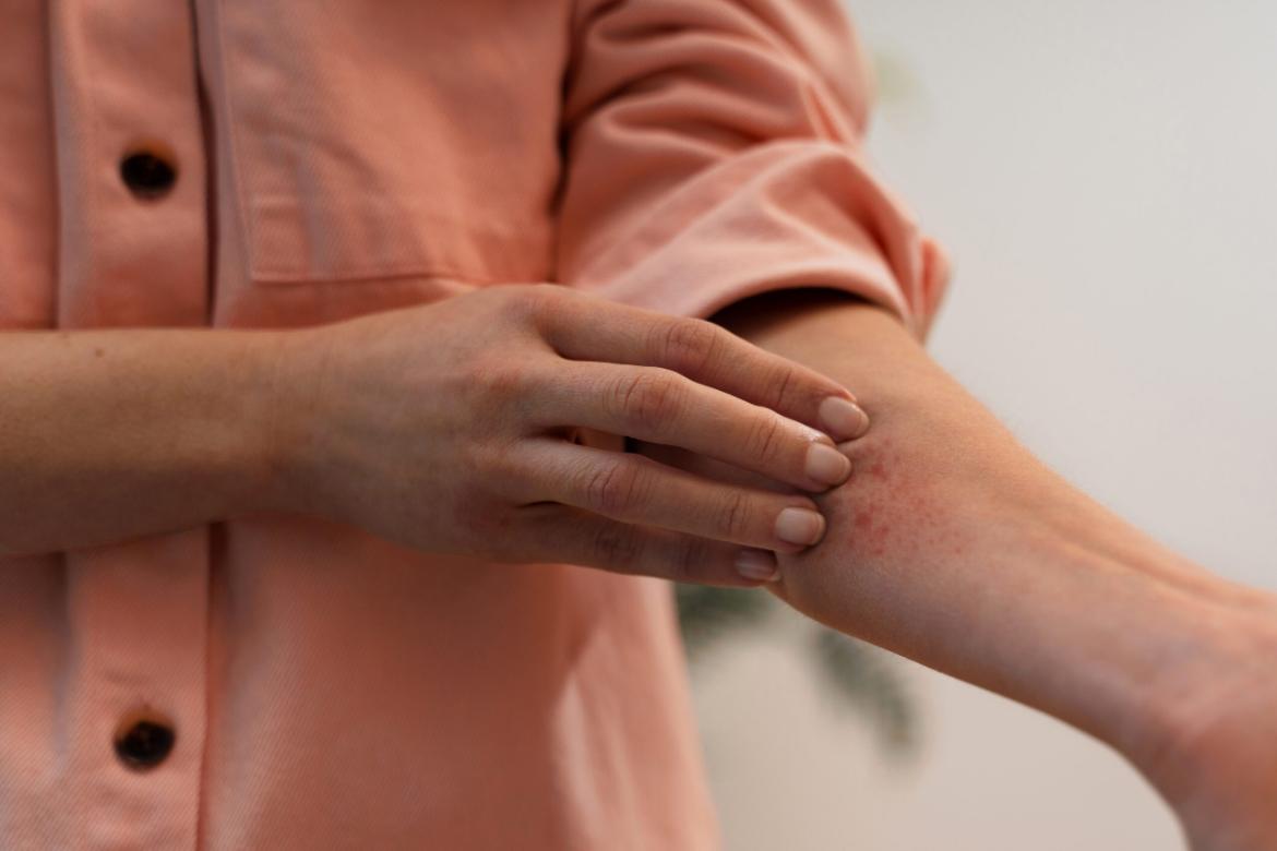 Anthrax Disease
