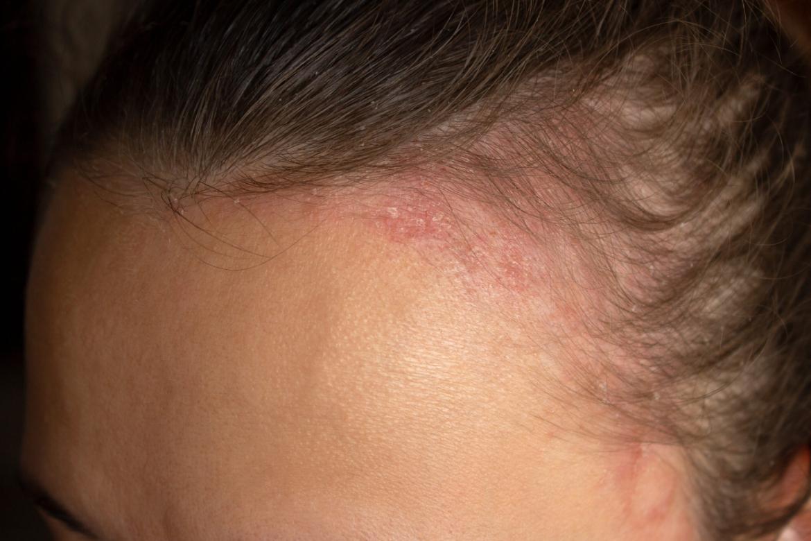 Seborrheic Dermatitis