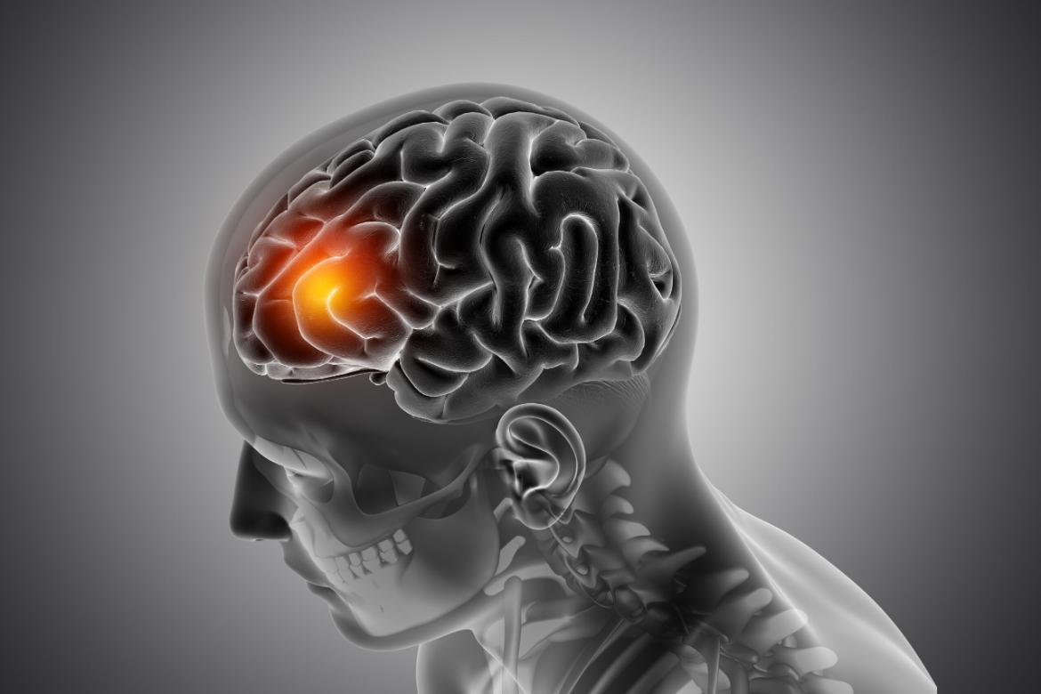 Cerebrovascular Disease