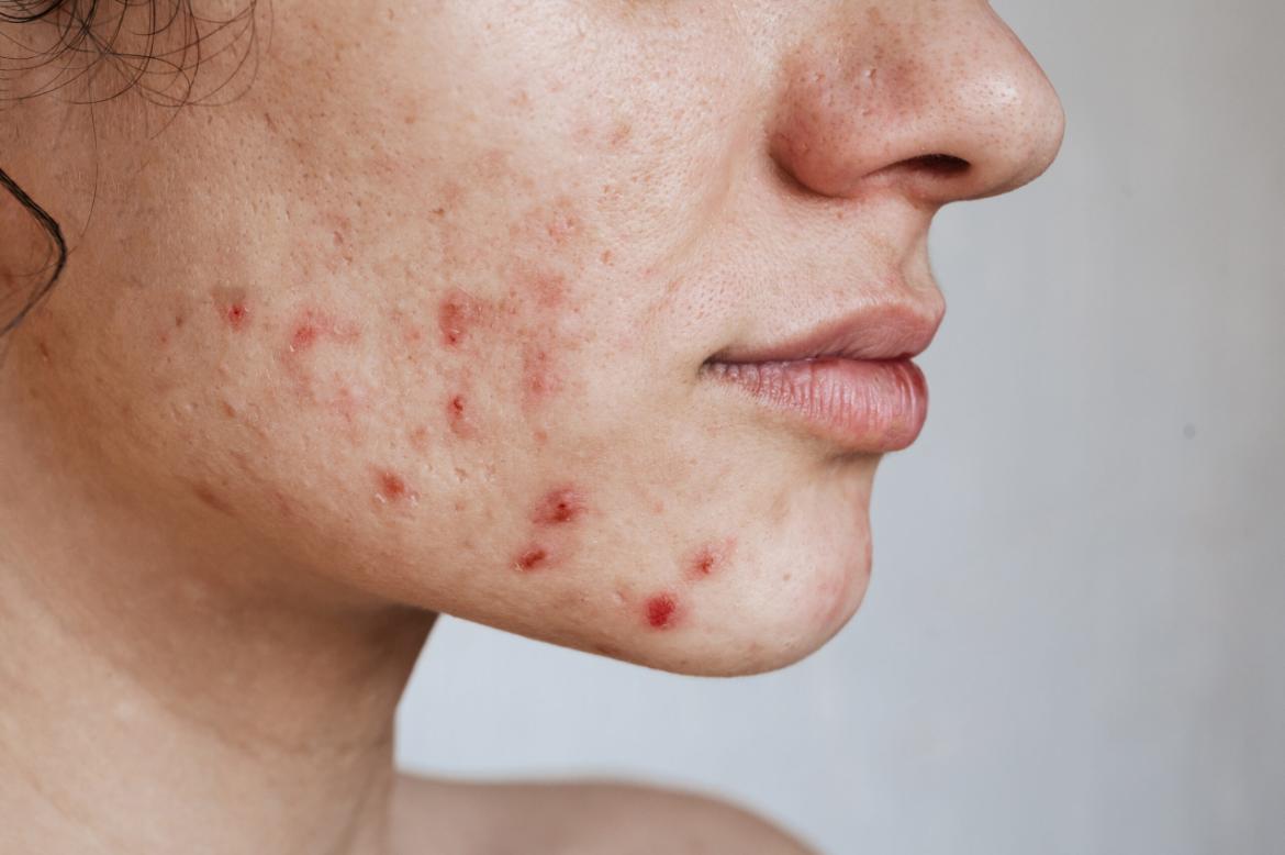 What is Acne and Why Does It Occur?