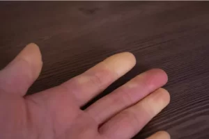 Cyanosis