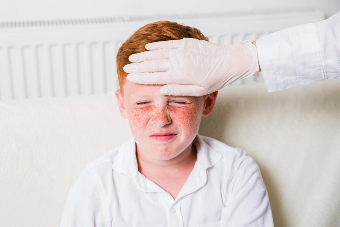 Stevens-Johnson Syndrome