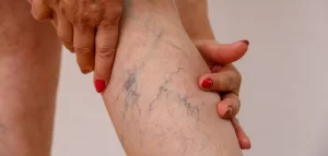 What is Varicose Vein Surgery?