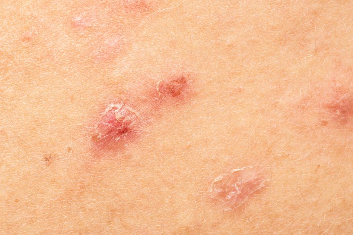 Vasculitis