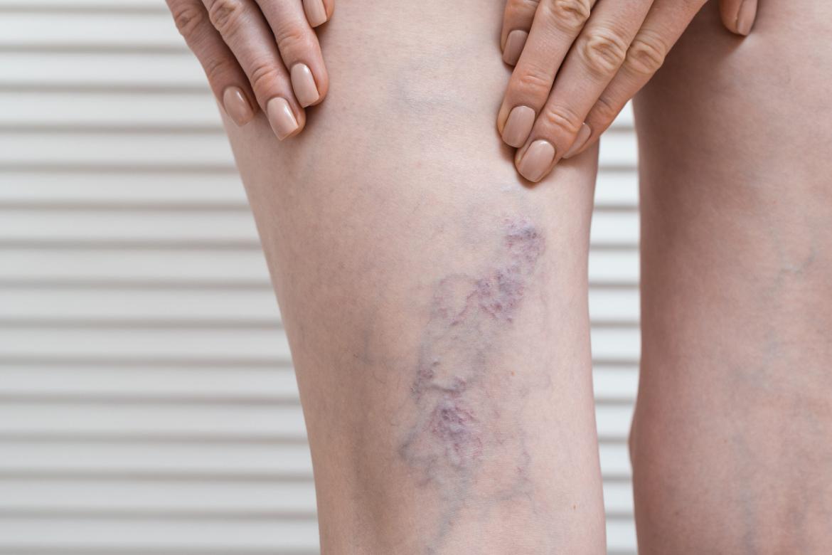 Venous Insufficiency