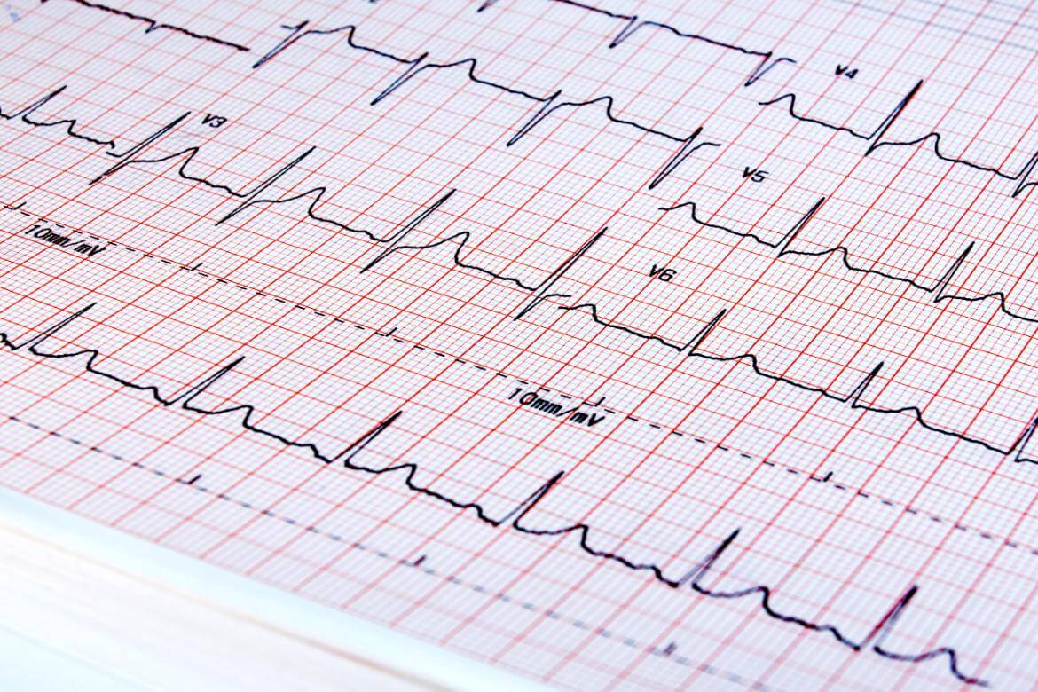 Wolff-Parkinson White Syndrome