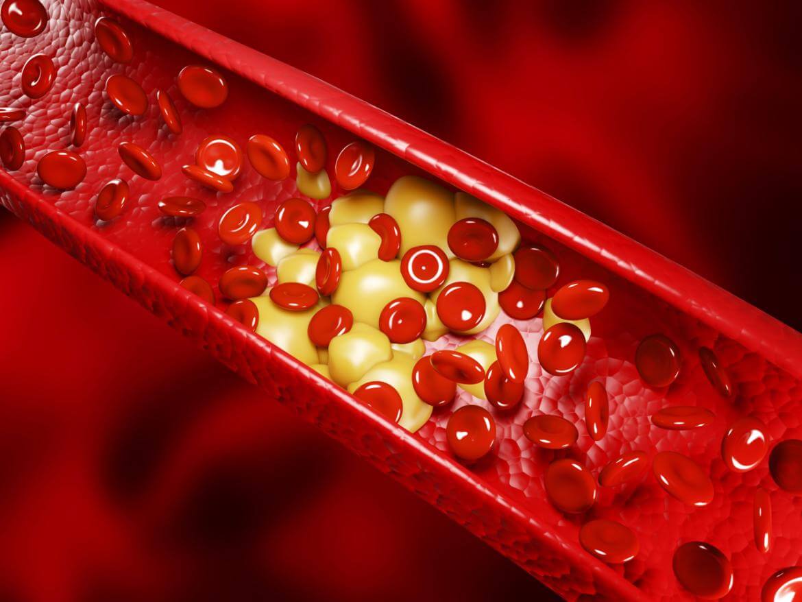 High Cholesterol (Hyperlipidemia)