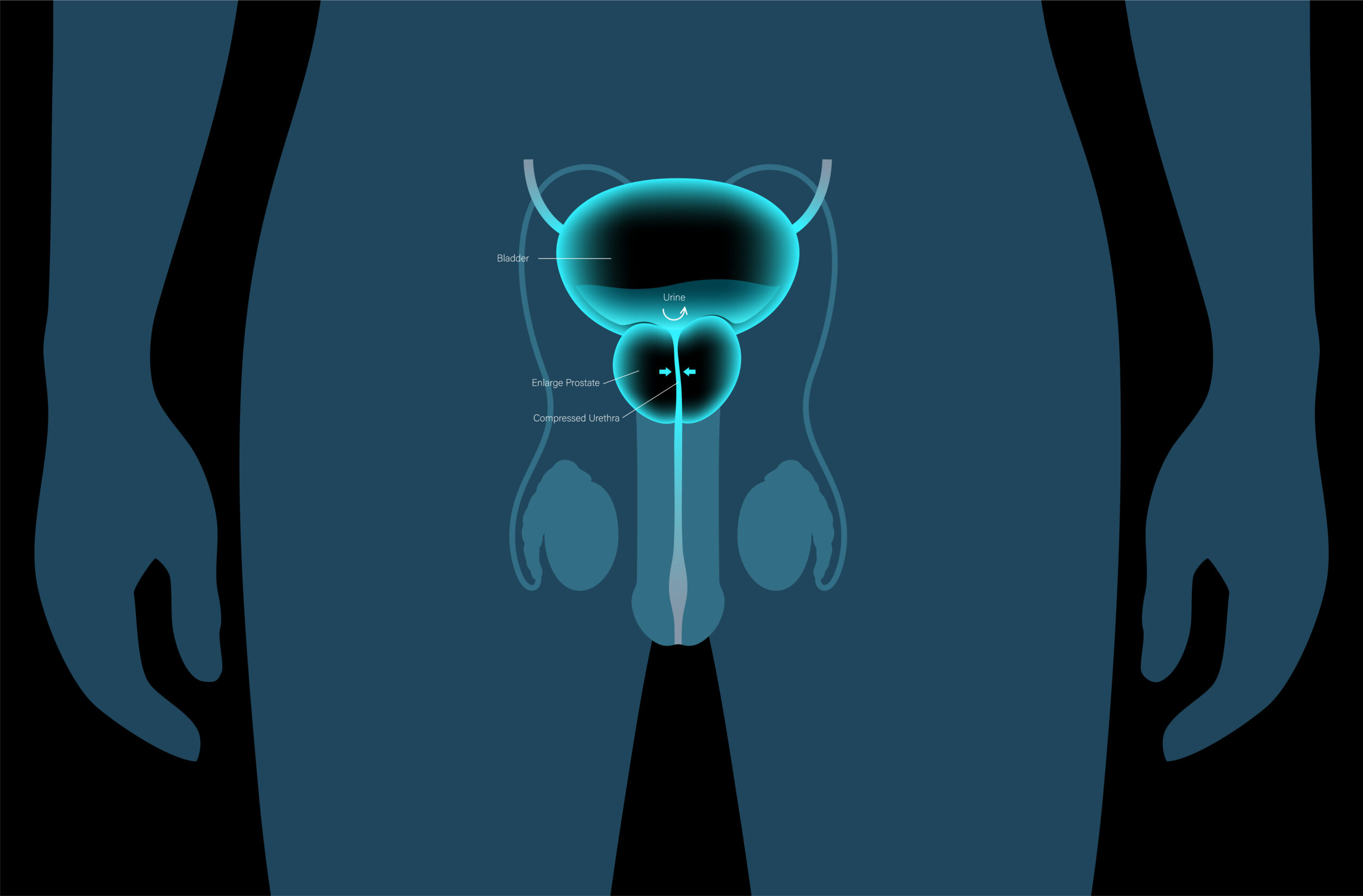 Açık Prostat Ameliyatı Nedir, Nasıl Yapılır?