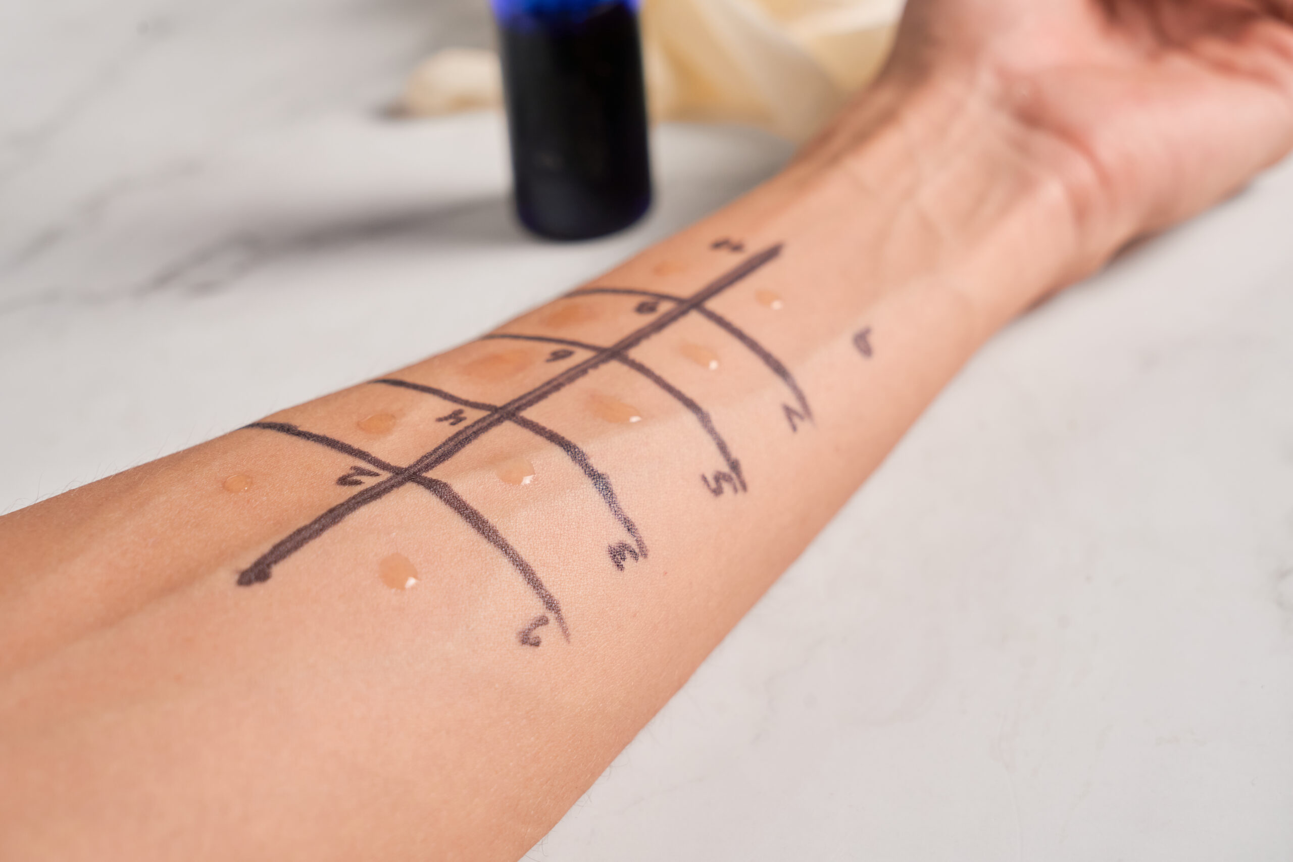 Alerji Deri Testi &#8211; Deri Prick Testi