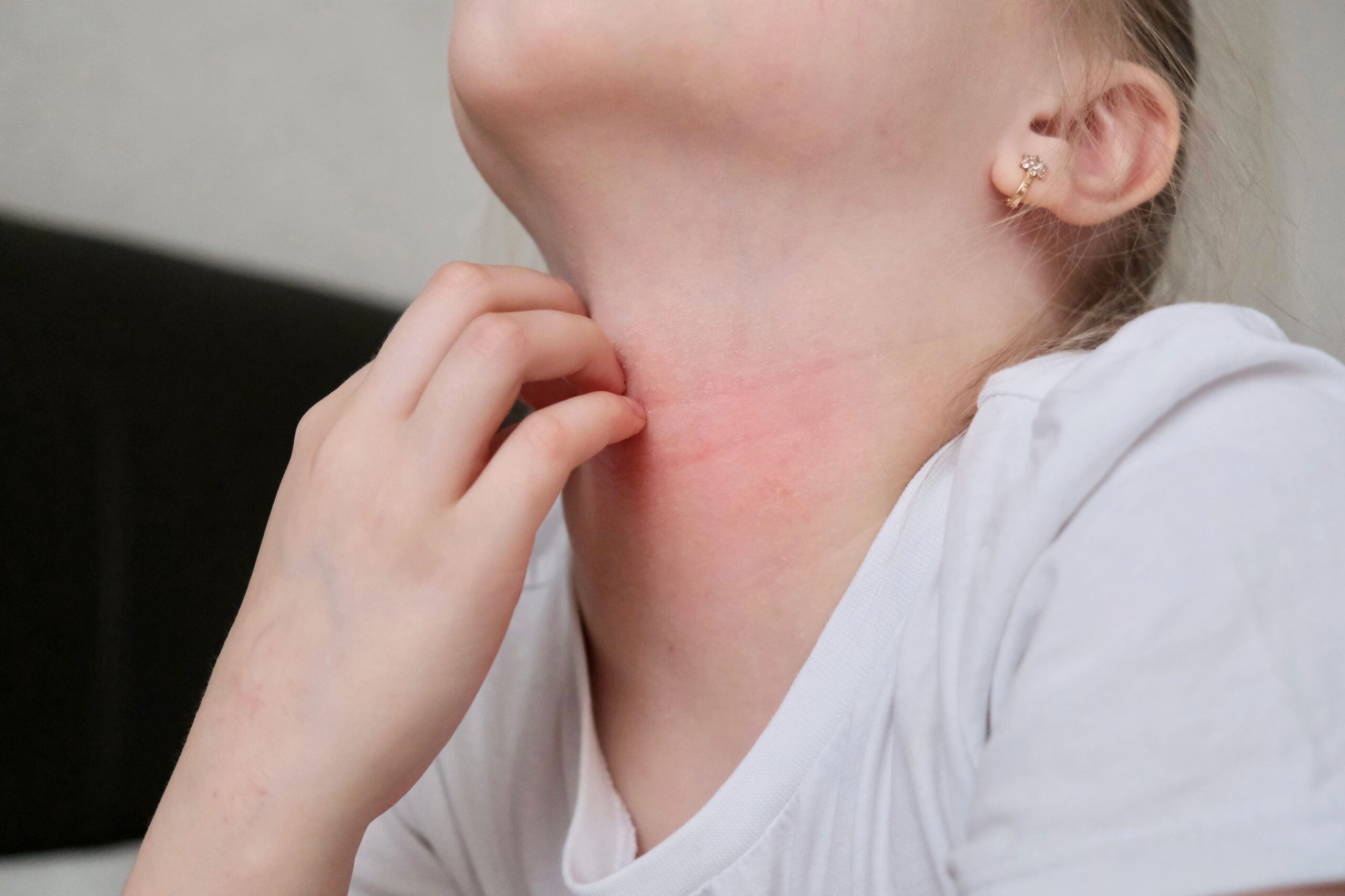 Bademcik İltihabı (Tonsilit)