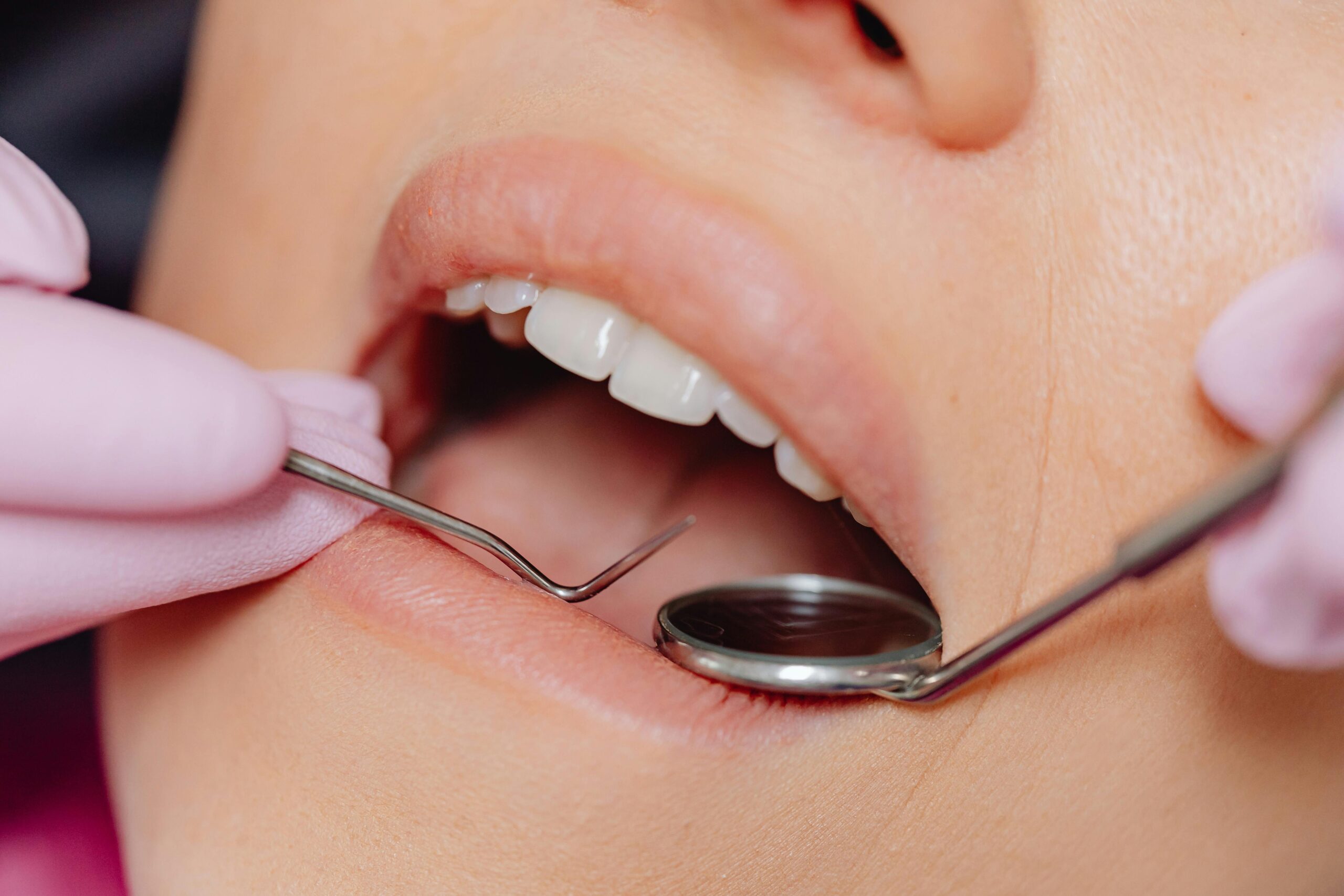 Diş Eti İltihabı (Gingivitis) Nedir? Belirtileri ve Tedavisi