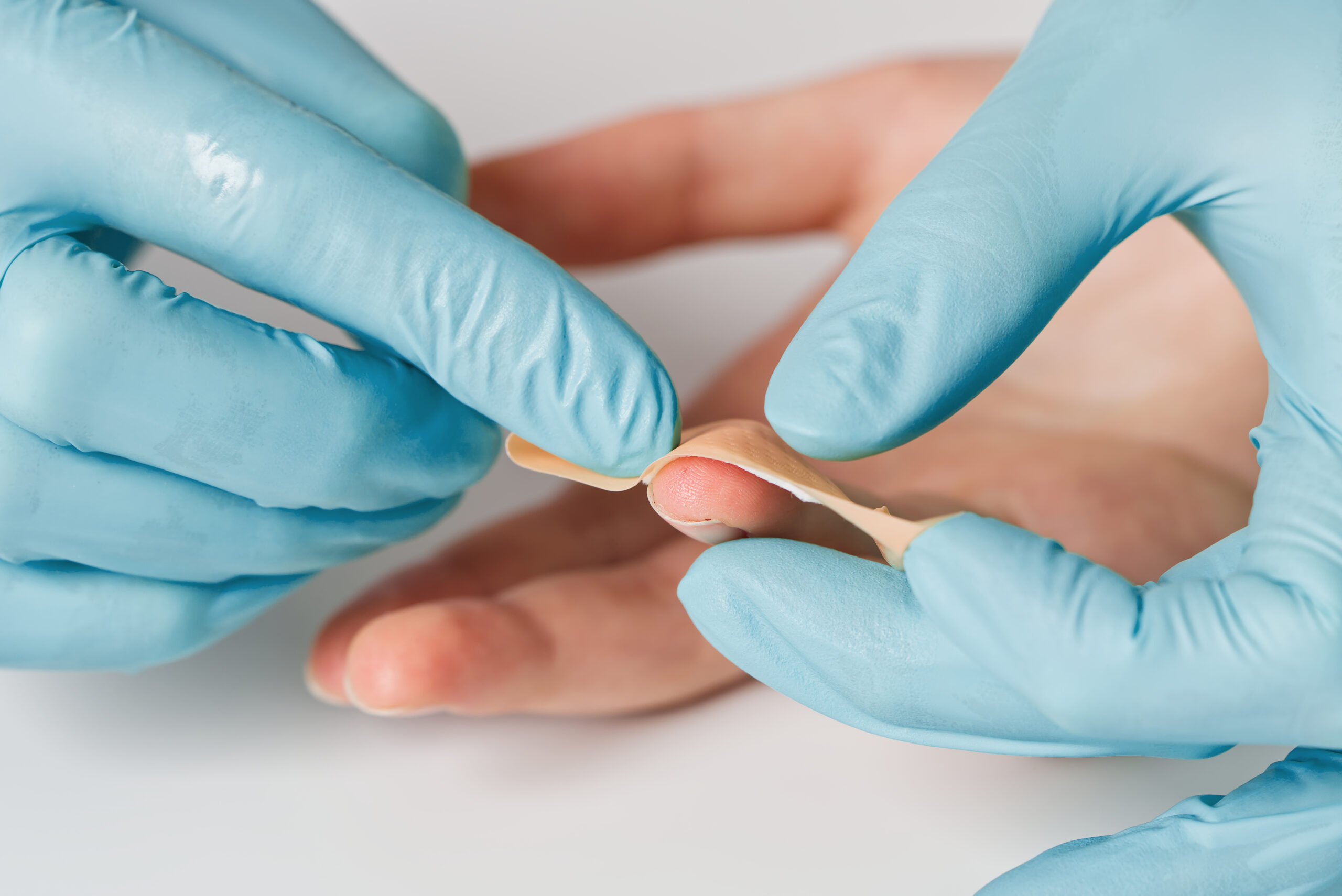 Dolama (Tırnak Enfeksiyonu)