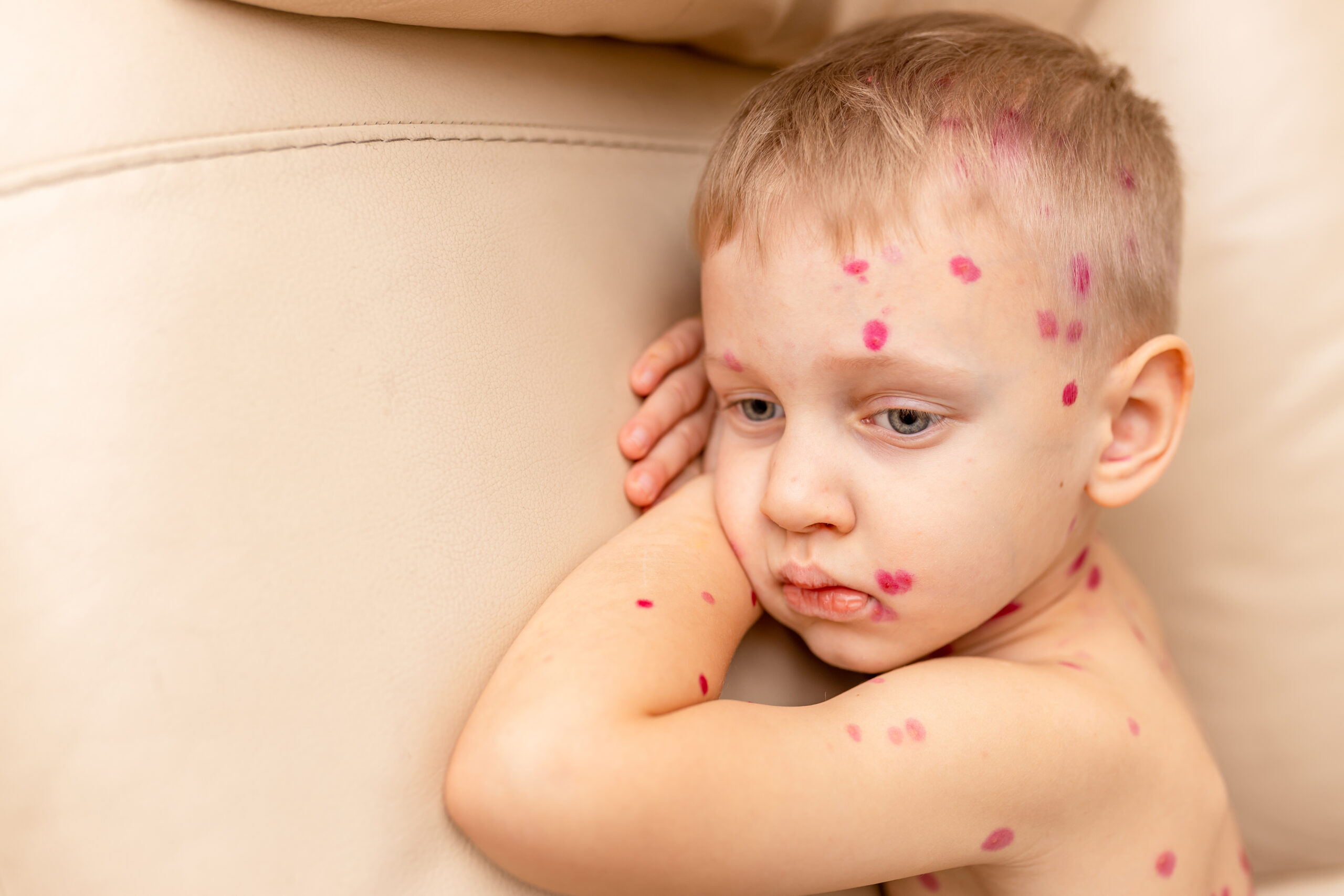 İmpetigo Nedir? İmpetigo Bulaşma Yolları