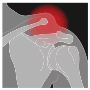 Omuz Artroskopisi Nedir?