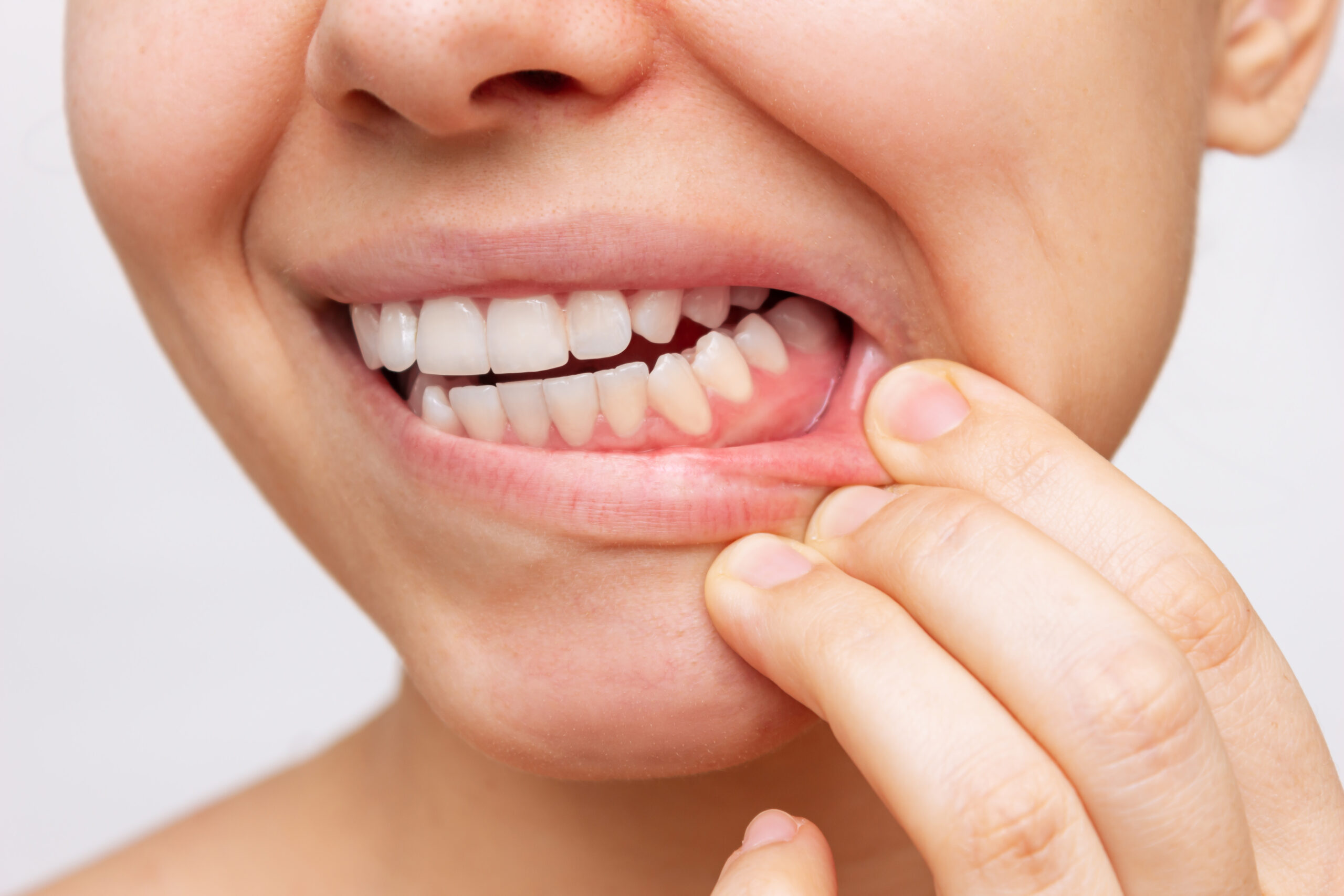 Skorbüt Hastalığı Nedir? Belirtileri, Nedenleri ve Tedavisi