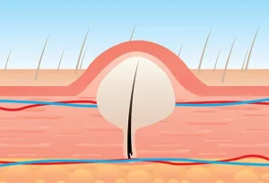 Pilonidal Sinüs