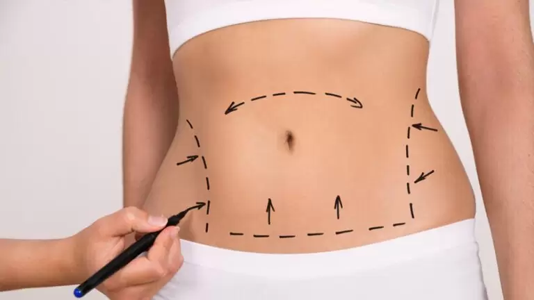 Karın Germe Ameliyatı (Abdominoplasti)