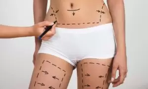 Liposuction (Yağ Aldırma) Ameliyatı