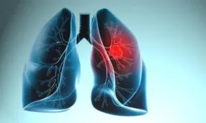 Akciğer Kanaması Nedir: Belirtileri, Nedenleri ve Tedavi Yöntemleri