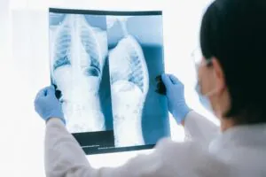 Güvercin göğsü (Kunduracı göğsü) nedir? Tedavisi nasıl yapılır?